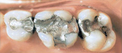 Perfect Smile amalgam restorations